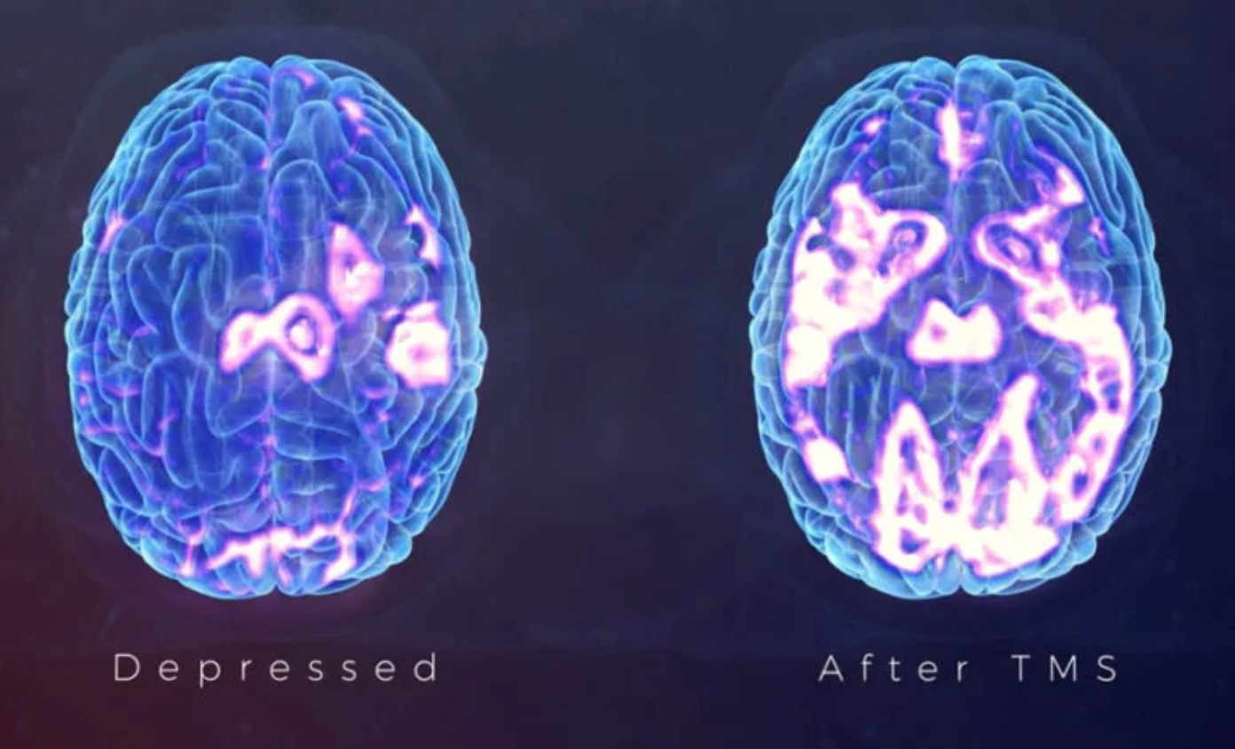 Brain scan comparison: depressed brain activity vs. brain activity after TMS treatment
